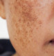 Különböző típusok

A melasma kezelése nehéz, mert bizonyos hormonális hatások és a krónikus napfényexpozíció okozza, a terhesség hormonális változásai és az orális fogamzásgátlók használata pedig tovább súlyosbíthatja a helyzetet. A poszt-inflammációs hiperpigmentáció a bőr fizikai sérüléseiből ered, mint például karcolás, kiütés vagy makacs pattanások. Bizonyos irodai kezelések után, például erős lézerek és hámlasztók alkalmazása után is megjelenhet. A napfény okozta hiperpigmentáció pedig a krónikus napkárosodásból ered.